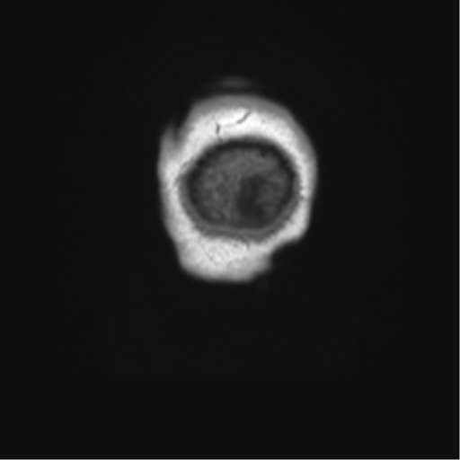 Clival chordoma invading the hypoglossal canal (Radiopaedia 48850-53887 Coronal T1 2).png