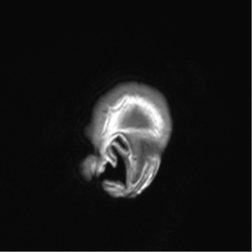 Clival chordoma invading the hypoglossal canal (Radiopaedia 48850-53887 Sagittal T1 90).png