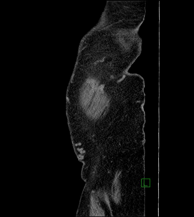 Closed-loop small bowel obstruction-internal hernia (Radiopaedia 78439-91096 C 137).jpg