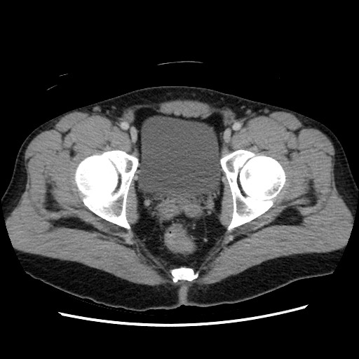 Closed-loop small bowel obstruction (Radiopaedia 73713-84509 A 160).jpg