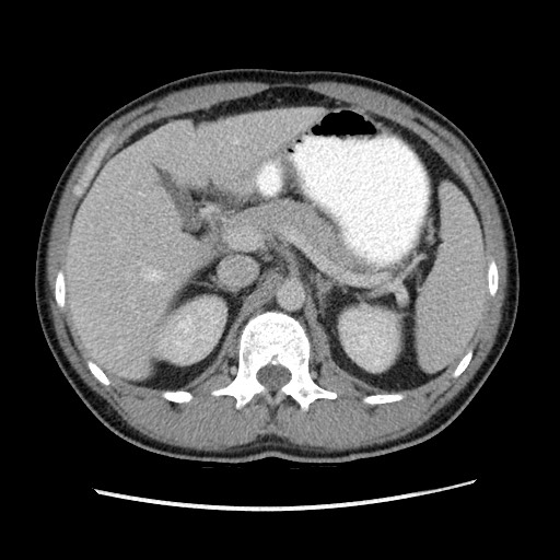 File:Closed-loop small bowel obstruction (Radiopaedia 73713-84509 A 53).jpg