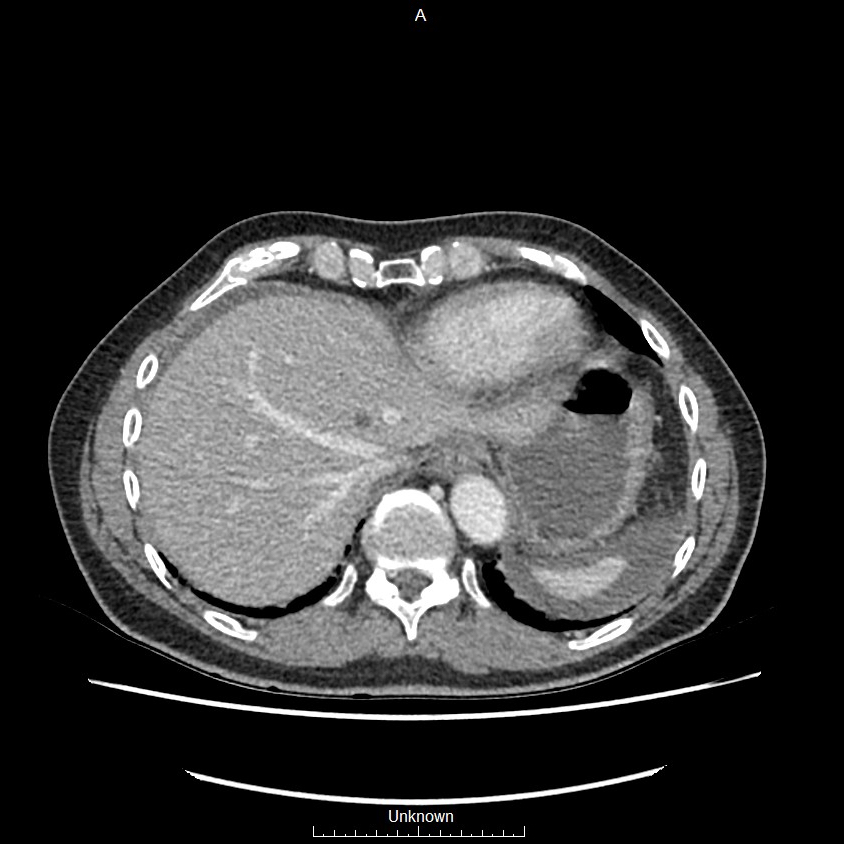 Closed loop bowel obstruction and ischemia (Radiopaedia 86959-103180 A 1).jpg