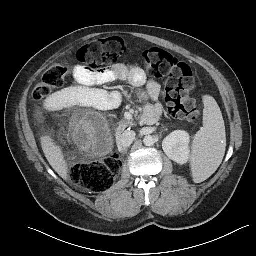 File:Closed loop obstruction - internal hernia into nephrectomy bed (Radiopaedia 59867-67320 A 54).jpg