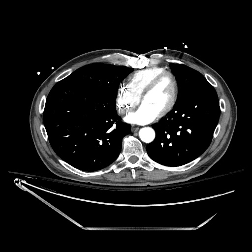 File:Closed loop obstruction due to adhesive band, resulting in small bowel ischemia and resection (Radiopaedia 83835-99023 B 8).jpg
