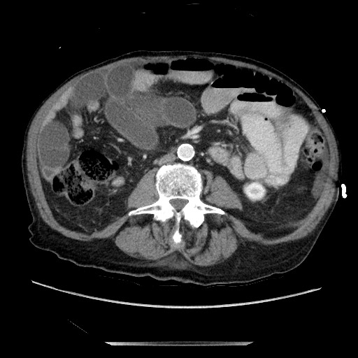 Closed loop small bowel obstruction - adhesive disease and hemorrhagic ischemia (Radiopaedia 86831-102990 A 104).jpg