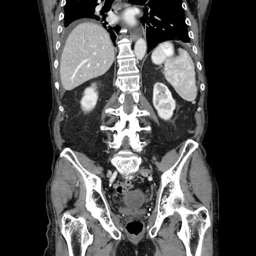Closed loop small bowel obstruction - adhesive disease and hemorrhagic ischemia (Radiopaedia 86831-102990 B 88).jpg