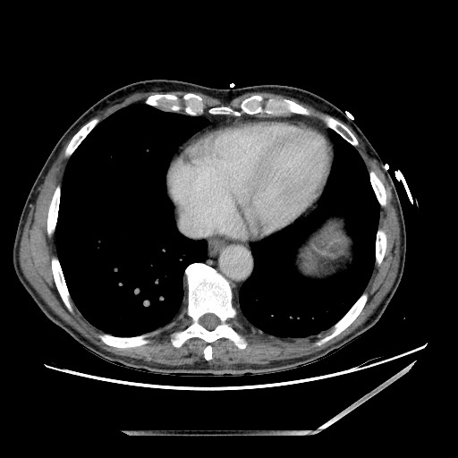 Closed loop small bowel obstruction - omental adhesion causing "internal hernia" (Radiopaedia 85129-100682 A 6).jpg