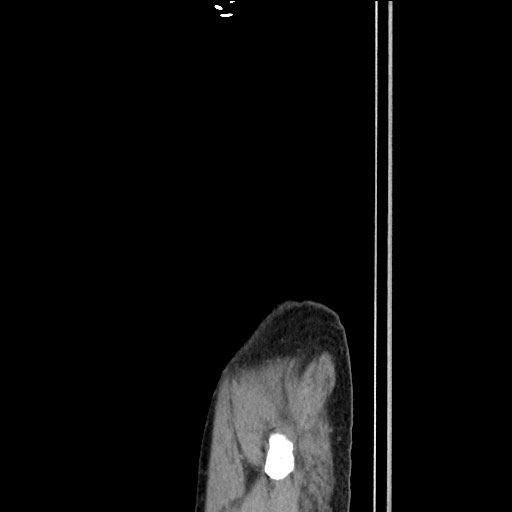 File:Closed loop small bowel obstruction - omental adhesion causing "internal hernia" (Radiopaedia 85129-100682 C 176).jpg