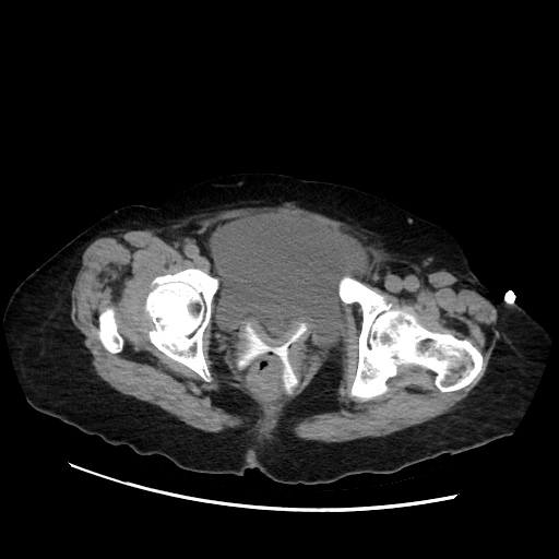 Closed loop small bowel obstruction due to adhesive band, with intramural hemorrhage and ischemia (Radiopaedia 83831-99017 Axial non-contrast 150).jpg