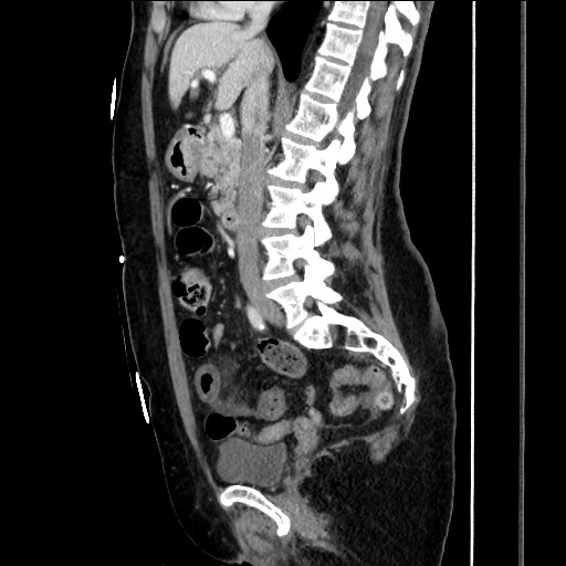 Closed loop small bowel obstruction due to adhesive bands - early and late images (Radiopaedia 83830-99014 C 86).jpg