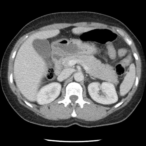 File:Closed loop small bowel obstruction due to trans-omental herniation (Radiopaedia 35593-37109 A 31).jpg