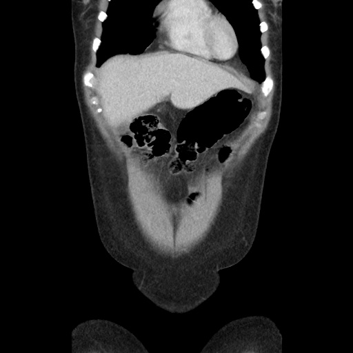 File:Closed loop small bowel obstruction due to trans-omental herniation (Radiopaedia 35593-37109 B 13).jpg