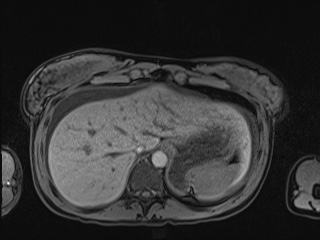 Closed loop small bowel obstruction in pregnancy (MRI) (Radiopaedia 87637-104031 Axial T1 fat sat 22).jpg