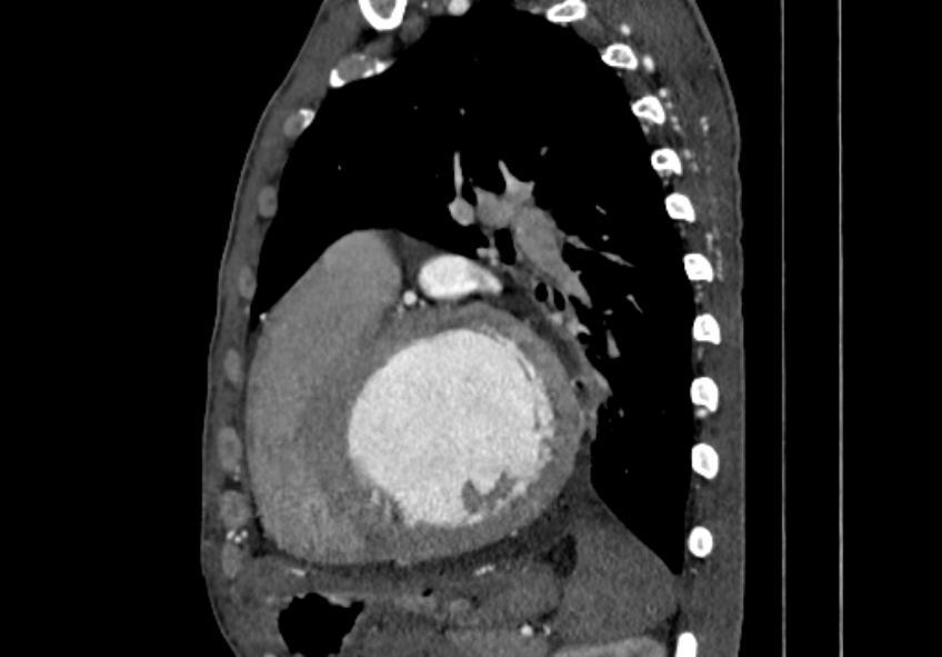 Coarctation of aorta with aortic valve stenosis (Radiopaedia 70463-80574 B 125).jpg
