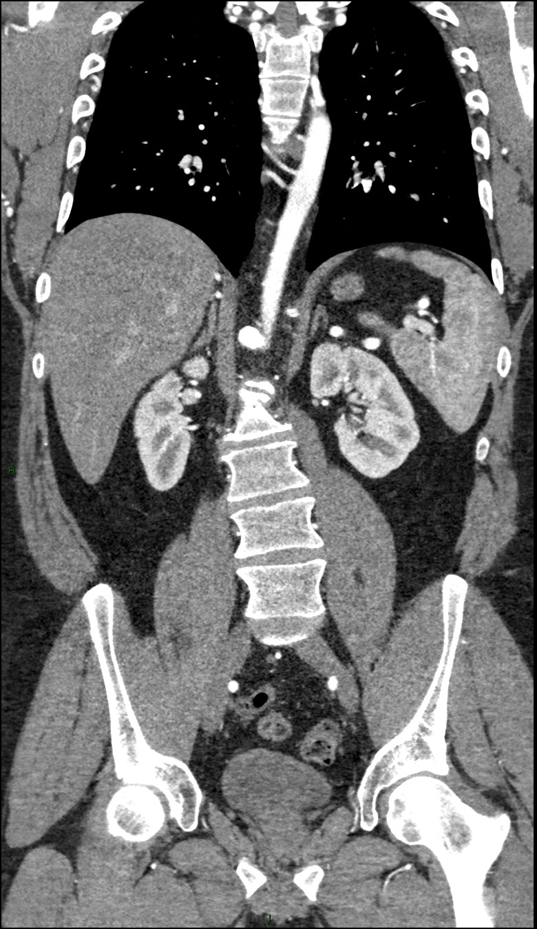 Coarctation of the aorta (Radiopaedia 74632-88521 B 150).jpg