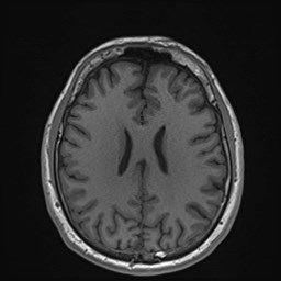 File:Cochlear incomplete partition type III associated with hypothalamic hamartoma (Radiopaedia 88756-105498 Axial T1 127).jpg