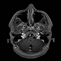 Cochlear incomplete partition type III associated with hypothalamic hamartoma (Radiopaedia 88756-105498 Axial T1 C+ 45).jpg