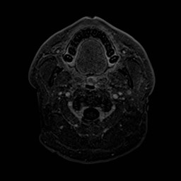 File:Cochlear incomplete partition type III associated with hypothalamic hamartoma (Radiopaedia 88756-105498 Axial T1 C+ 7).jpg