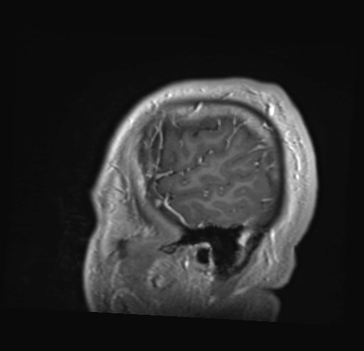 Cochlear incomplete partition type III associated with hypothalamic hamartoma (Radiopaedia 88756-105498 Sagittal T1 C+ 48).jpg