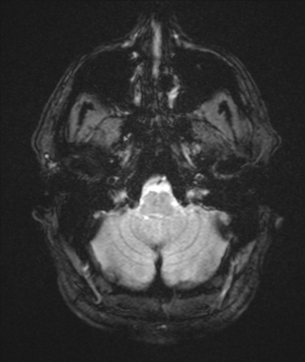 File:Colloid cyst (Radiopaedia 44510-48181 Axial Gradient Echo 5).png