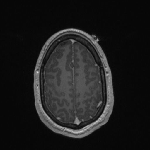File:Colloid cyst (Radiopaedia 44510-48181 Axial T1 C+ 150).png
