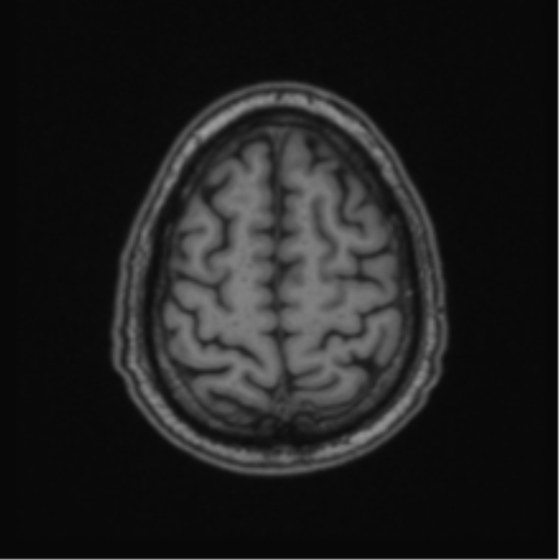File:Colloid cyst of the third ventricle (Radiopaedia 86571-102662 Axial T1 65).png
