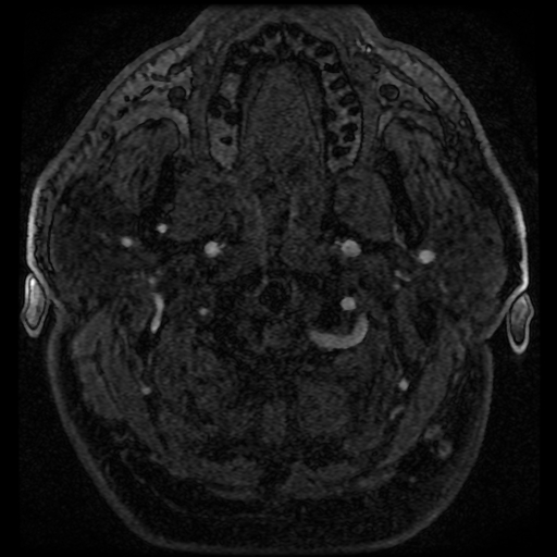 File:Colloid cyst with anterior communicating artery aneurysm (Radiopaedia 33901-35091 Axial MRA 15).jpg