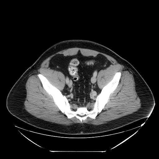 Colocolic intussusception due to lipoma (Radiopaedia 73712-84508 A 97).jpg