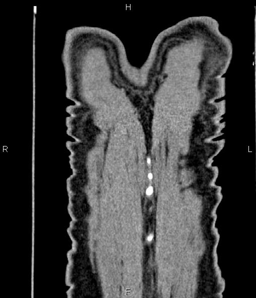 Colon adenocarcinoma (Radiopaedia 83266-97671 C 68).jpg