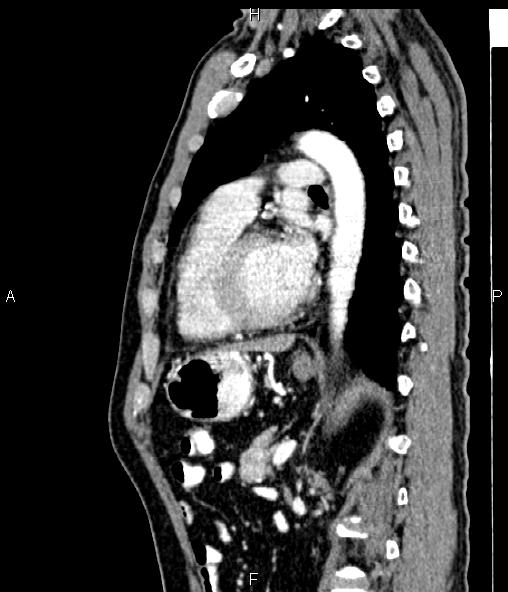 Colon adenocarcinoma (Radiopaedia 83266-97671 D 69).jpg
