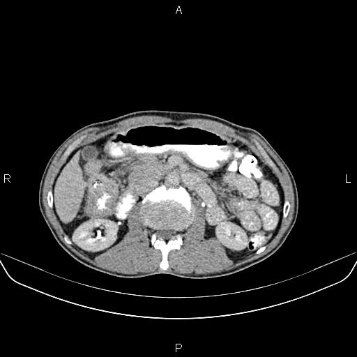 File:Colon adenocarcinoma - hepatic flexure (Radiopaedia 85635-101395 Axial C+ delayed 38).jpg