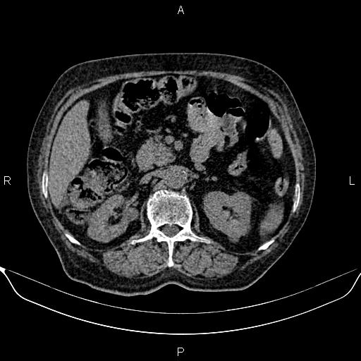 File:Colon cancer (Radiopaedia 90215-107432 Axial non-contrast 34).jpg