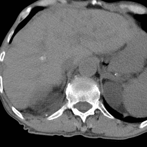 Colon cancer with calcified liver metastasis (Radiopaedia 74423-85309 Axial non-contrast 21).jpg