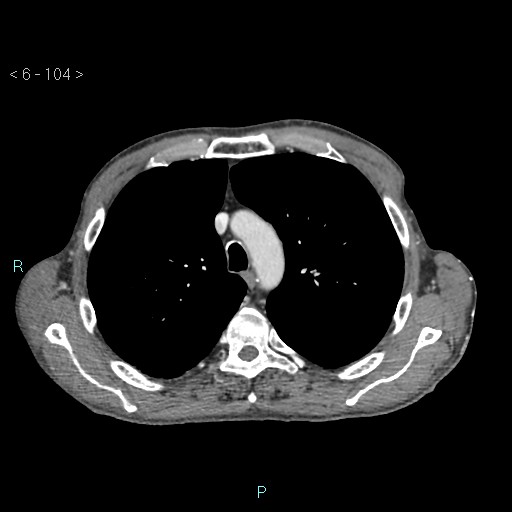 Colonic cancer (ultrasound and TC imaging) (Radiopaedia 50346-55713 B 104).jpg