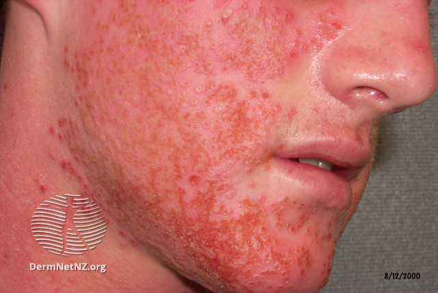 File:Eczema herpeticum (DermNet NZ viral-eczema-herpticum06).jpg
