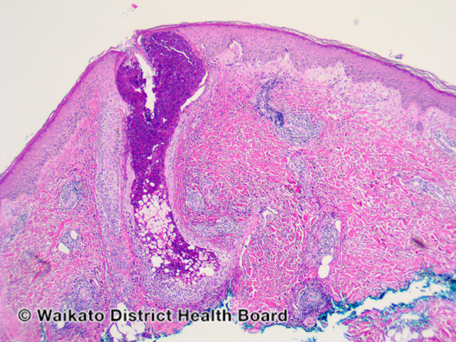 File:Figure 4 (DermNet NZ pathology-w-eosinophilic-folliculitis-fig-4).jpg