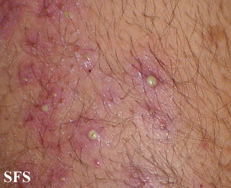 File:Folliculitis (Dermatology Atlas 8).jpg