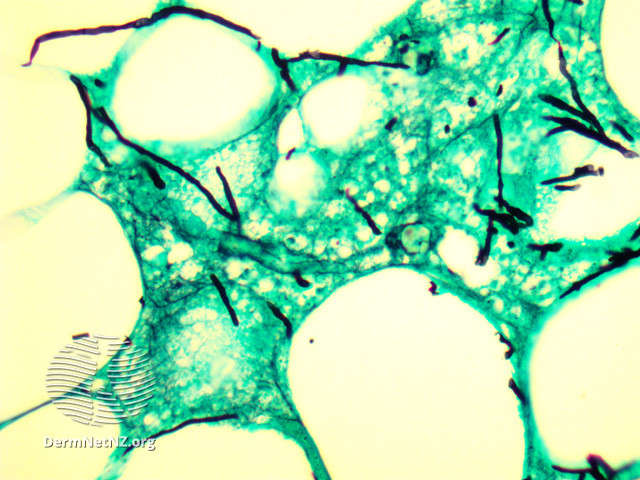 File:Histopathology (DermNet NZ fungal-aspergillus-01).jpg