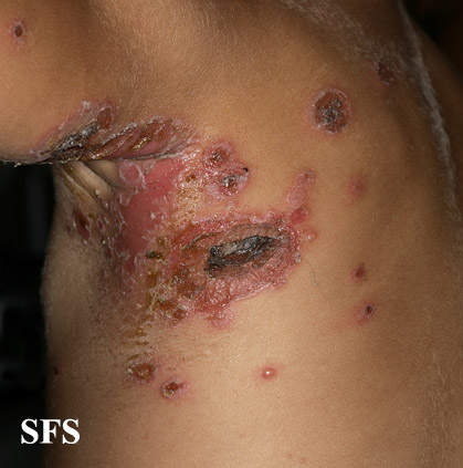 File:Impetigo (Dermatology Atlas 61).jpg