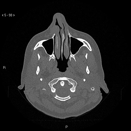 Nasolabial cyst (Radiopaedia 75125-86194 Axial bone window 59).jpg