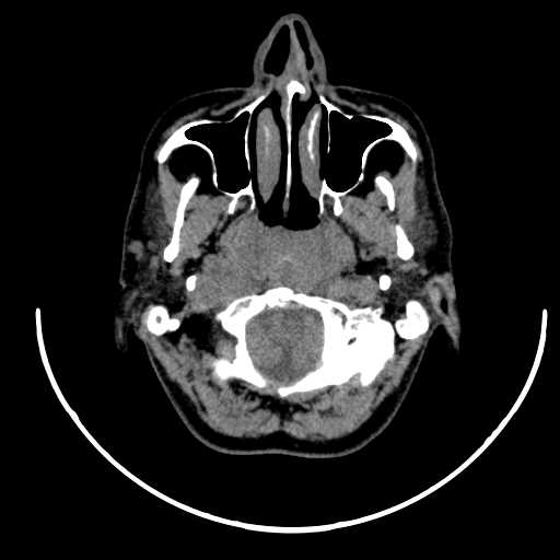 File:Nasopharyngeal carcinoma - infiltrating the clivus (Radiopaedia 62583-70875 Axial non-contrast 17).jpg
