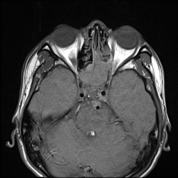 Nasopharyngeal carcinoma with skull base invasion (Radiopaedia 53415-59485 Axial T1 18).jpg