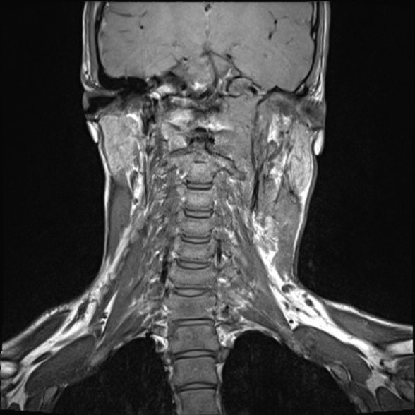 Nasopharyngeal carcinoma with skull base invasion (Radiopaedia 53415-59485 Coronal T1 14).jpg