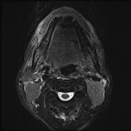 File:Nasopharyngeal carcinoma with skull base invasion (Radiopaedia 59258-66600 D 37).jpg