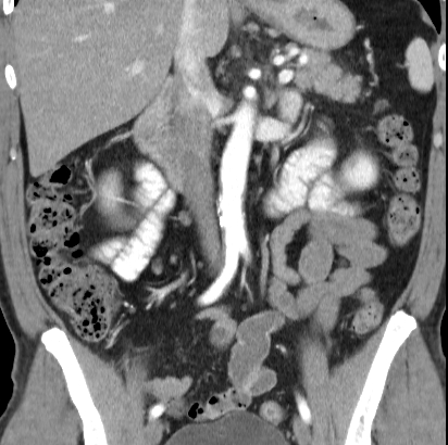 File:Necrotizing pancreatitis with acute necrotic collection (Radiopaedia 14470-14417 C 21).jpg
