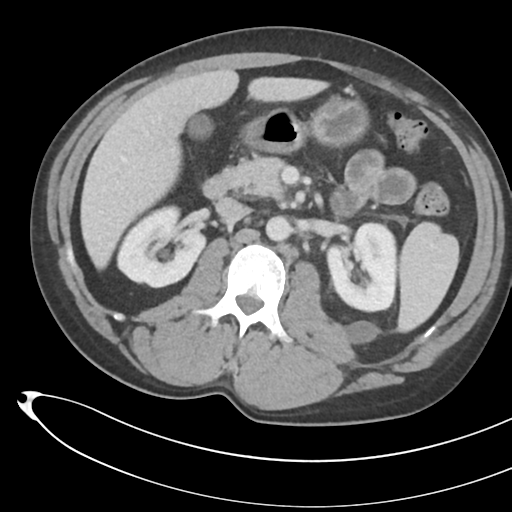 File:Necrotizing pancreatitis with acute necrotic collections (Radiopaedia 38829-41012 B 34).png