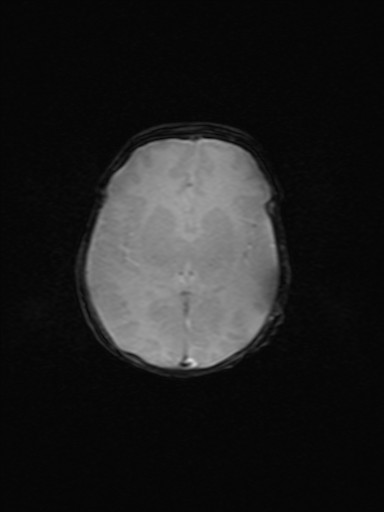 File:Neonatal hypoxic-ischemic encephalopathy (Radiopaedia 41406-44277 Axial Gradient Echo 10).jpg