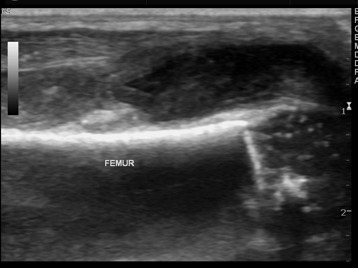 File:Neonatal knee septic arthritis (Radiopaedia 13358-13360 B 1).jpg
