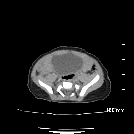 File:Neonatal neuroblastoma (Radiopaedia 56651-63438 Axial non-contrast 62).jpg
