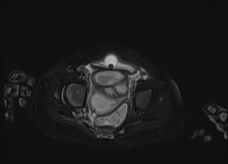 Neonatal prostatic utricle abscess - cyst (Radiopaedia 69511-79394 Axial T2 fat sat 19).jpg